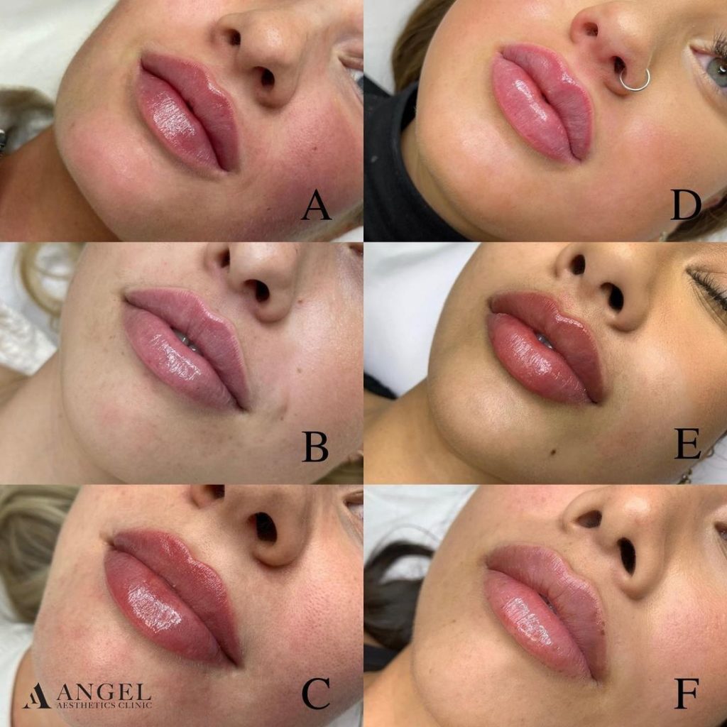 Before and after results of lip fillers in Gold Coast, Queensland